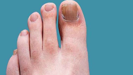 How to prevent the appearance of nail fungus?